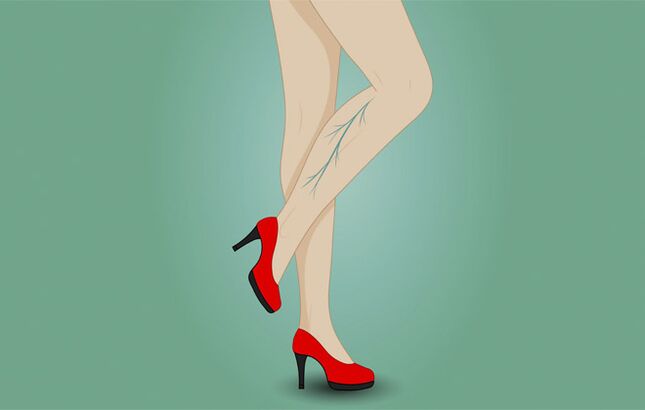 Varicose veins in a woman's legs