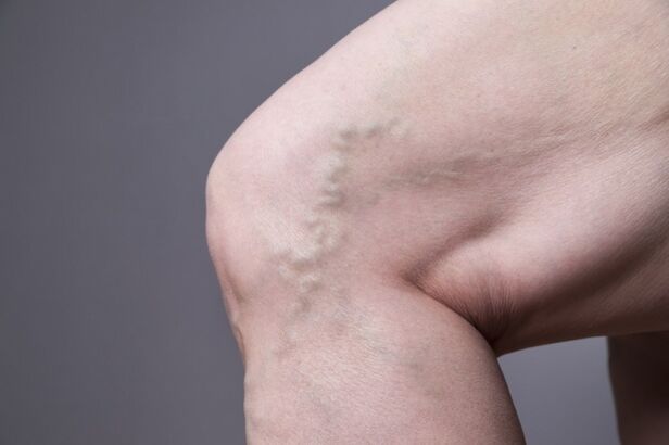 Veins varicose veins in women