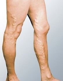 Varicose veins on a man's legs