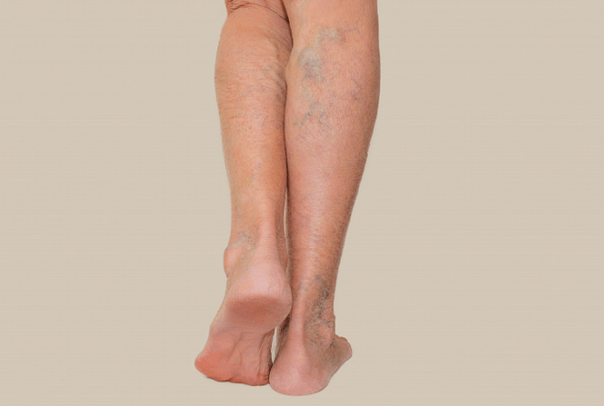 varicose veins in the legs
