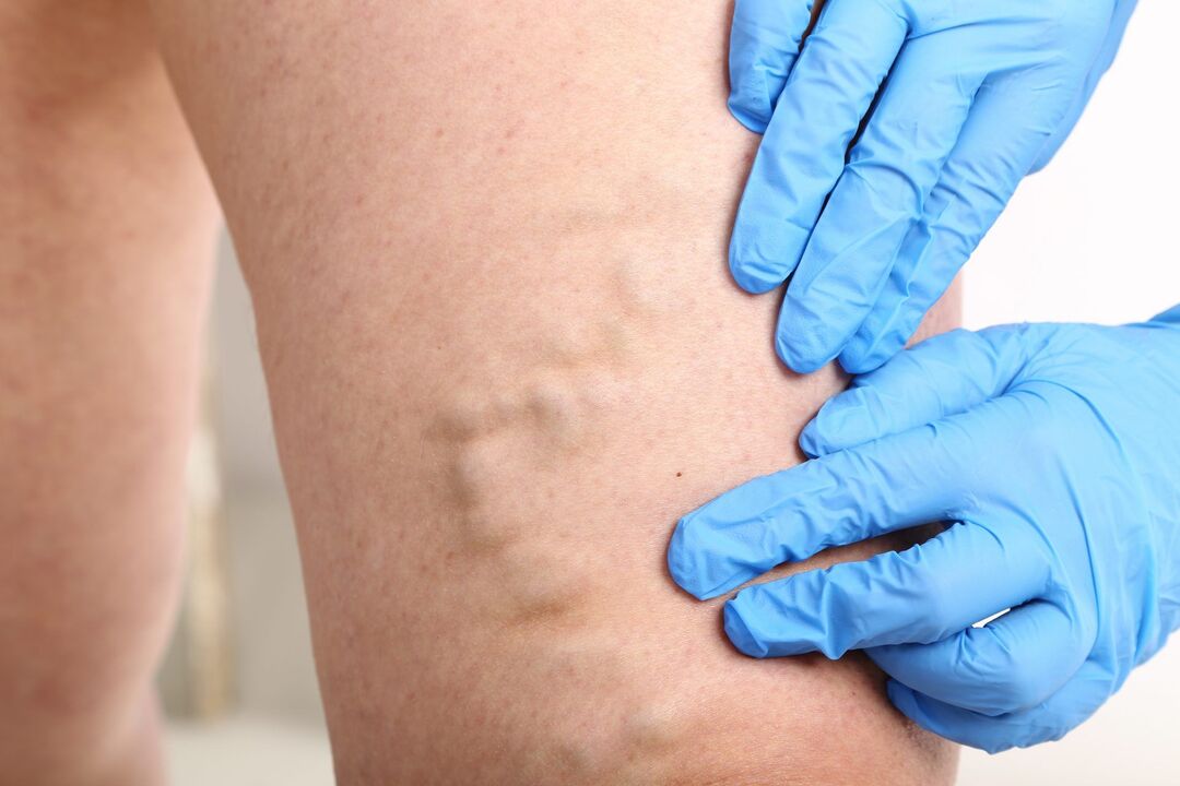 varicose veins signs