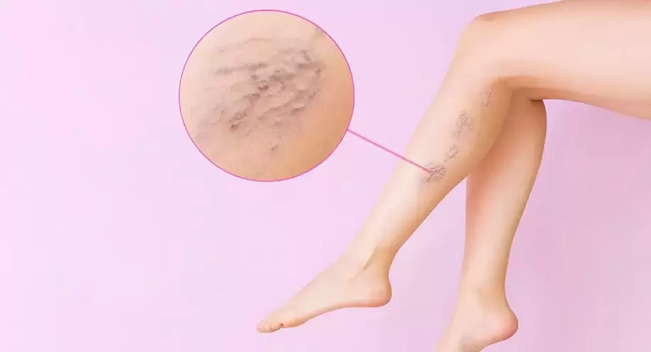 Crooked bulging veins on legs with varicose veins