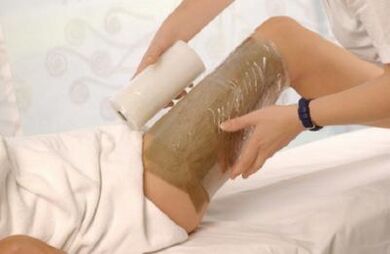 Acetic wraps have proven to be effective for varicose veins on the legs