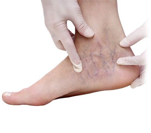 varicose veins diagnosis