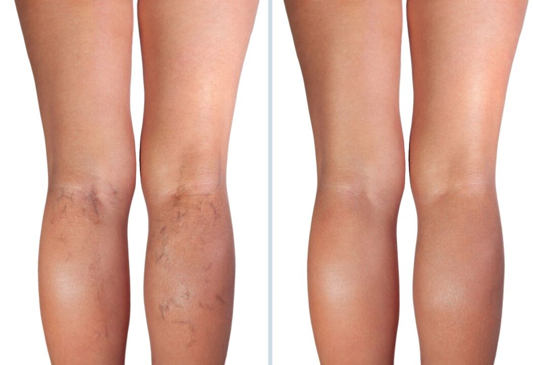 varicose veins stages