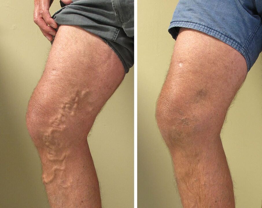 Superficial vessel varicose veins cannot be ignored